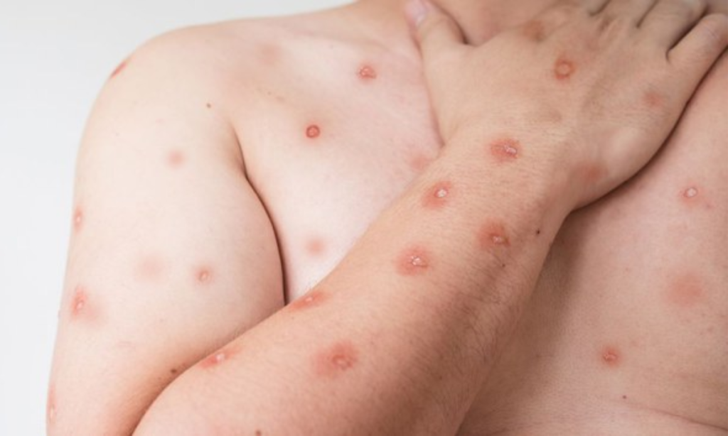 Mpox tem 15 casos confirmados no estado do Rio