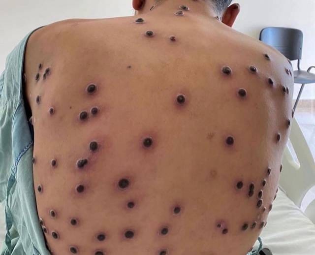 Exemplo 2 de Mpox