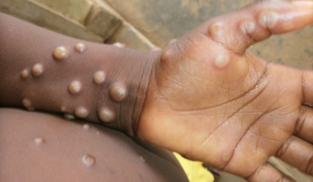 Exemplo 3 de Mpox