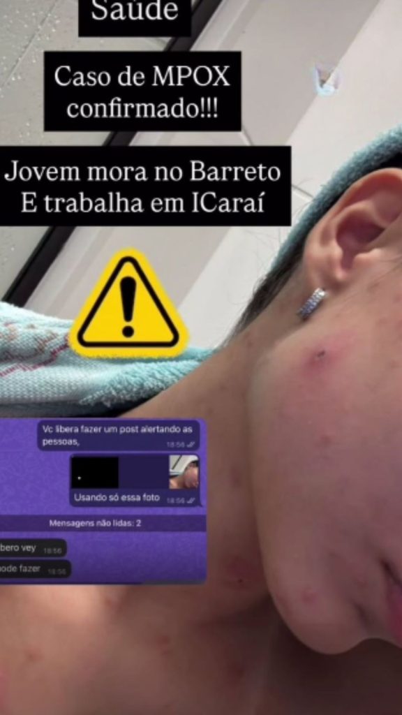 relato de mpox em niterói