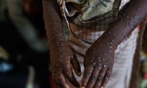 Mpox chega em 140 casos confirmados no Brasil
