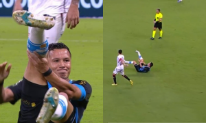 Marlon, do Grêmio, tem fratura feia contra o Vitória.