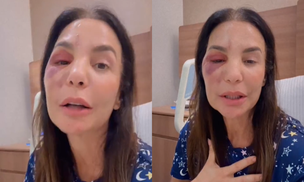 Ivete Sangalo fala sobre fratura no rosto
