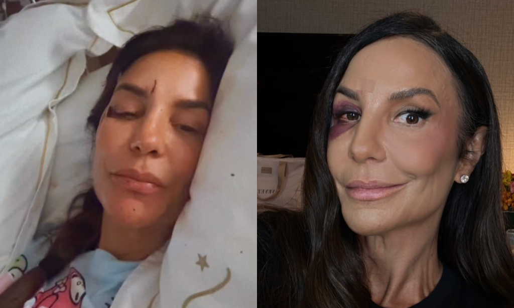Ivete Sangalo é submetida a longa cirurgia para corrigir fratura no rosto