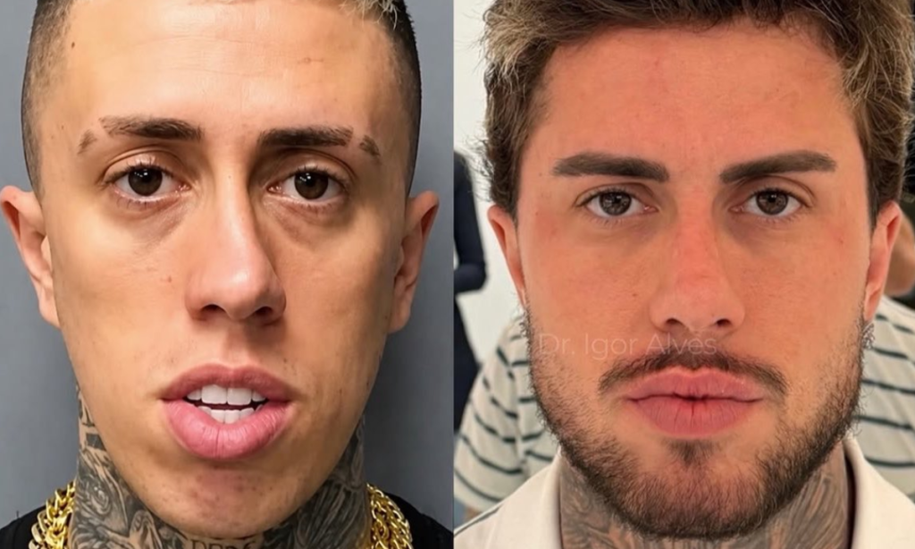 MC Daniel faz nova harmonização facial e choca com visual repaginado