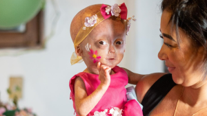 Irmã gêmea com velhice precoce rara morre aos 5 anos